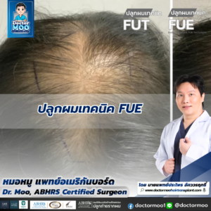 ปลูกผมเทคนิค FUE