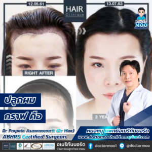 ปลูกผม กราฟ คือ