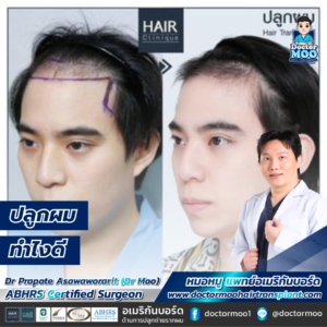 ปลูกผม ทำไงดี