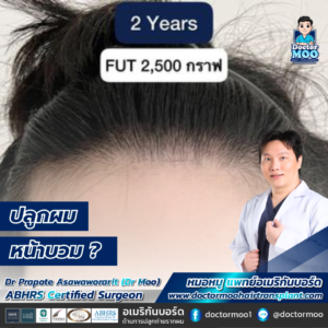 ปลูกผม หน้าบวม 