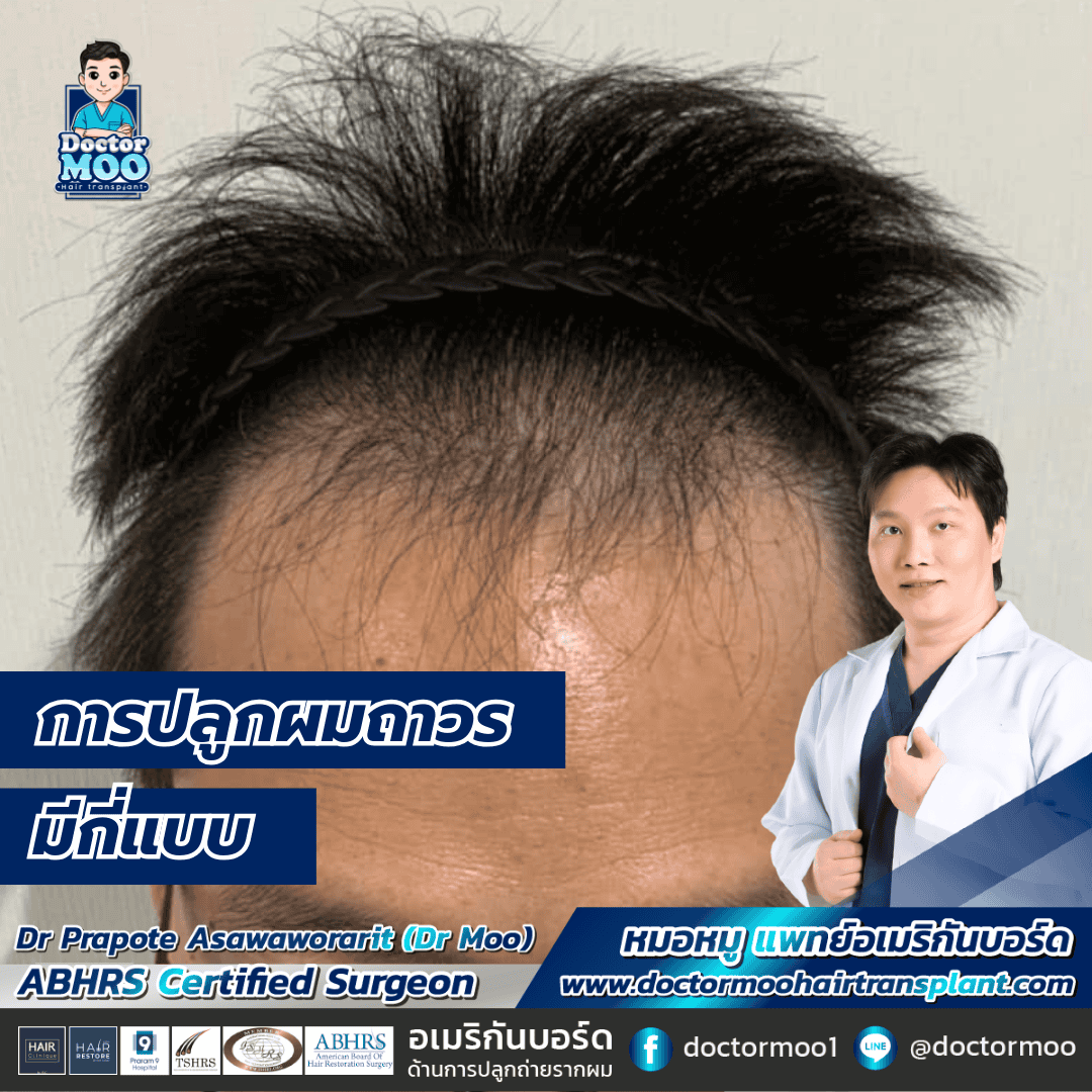 การปลูกผมถาวรมีกี่แบบ