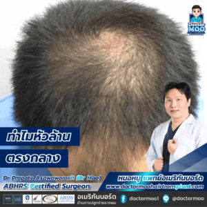 ทำไมหัวล้านตรงกลาง 