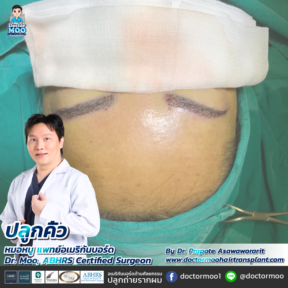 ปลูกคิ้ว