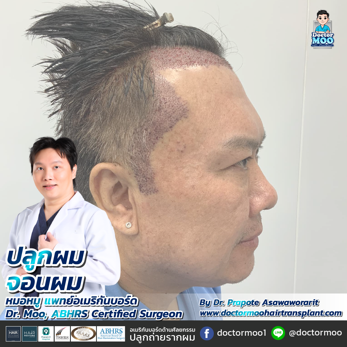 ปลูกจอนผม