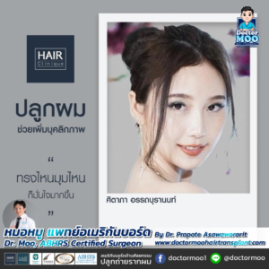 รีวิวปลูกผม หมอหมู