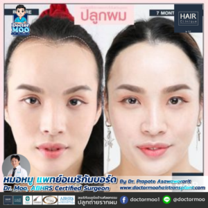 ปลูกผม LGBT