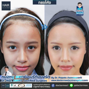 ปลูกผมผู้หญิง