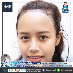 ปลูกผมผู้หญิง