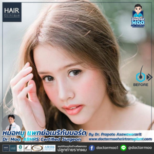 ปลูกผมผู้หญิง