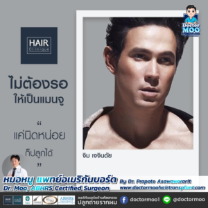 รีวิวปลูกผม หมอหมู