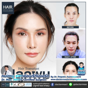 ปลูกผมผู้หญิง