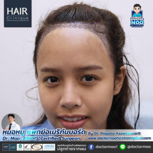 ปลูกผมผู้หญิง