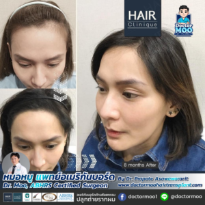 ปลูกผมผู้หญิง