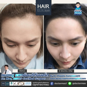 ปลูกผมผู้หญิง