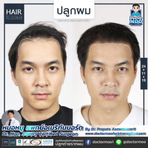 รีวิวปลูกผม หมอหมู