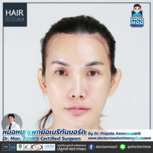 ปลูกผม LGBT