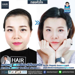 ปลูกผมผู้หญิง