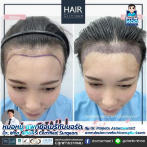 ปลูกผมผู้หญิง