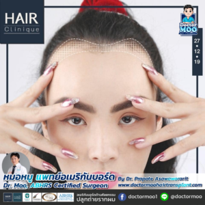 รีวิวปลูกผม หมอหมู