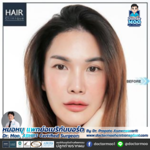 ปลูกผม LGBT