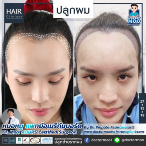 รีวิวปลูกผม หมอหมู