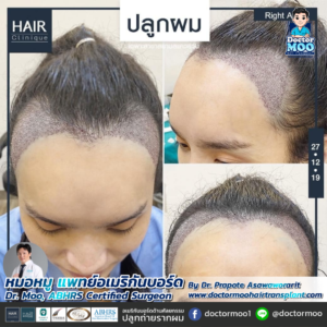 รีวิวปลูกผม หมอหมู