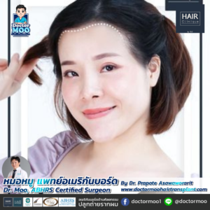 ปลูกผมผู้หญิง