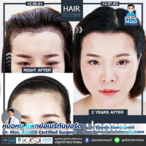 ปลูกผมผู้หญิง