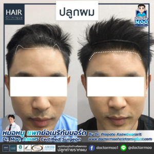 รีวิวปลูกผม หมอหมู