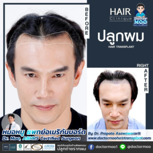 รีวิวปลูกผม หมอหมู