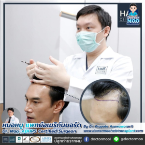 รีวิวปลูกผม หมอหมู