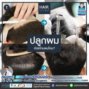 รีวิวปลูกผม หมอหมู