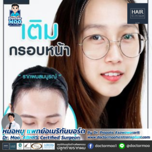 ปลูกผมผู้หญิง