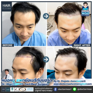 รีวิวปลูกผม หมอหมู