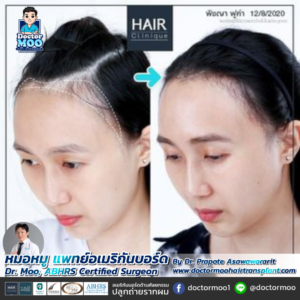 ปลูกผมผู้หญิง