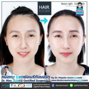 ปลูกผมผู้หญิง