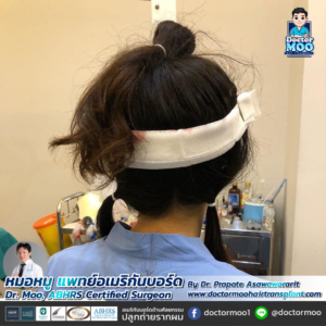 รีวิวปลูกผม หมอหมู