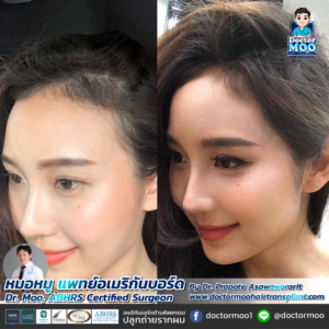 รีวิวปลูกผม หมอหมู