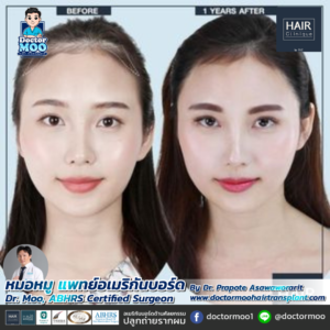 ปลูกผมผู้หญิง