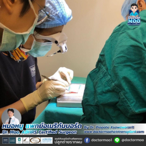 รีวิวปลูกผม หมอหมู