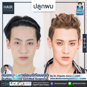 รีวิวปลูกผม หมอหมู