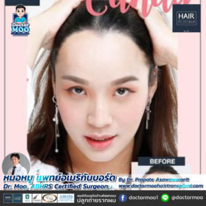 ปลูกผม LGBT