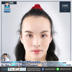 ปลูกผม LGBT