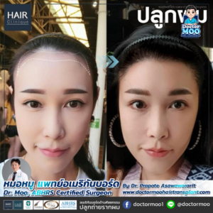 ปลูกผมผู้หญิง