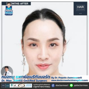 ปลูกผม LGBT