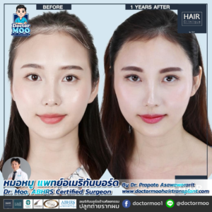 ปลูกผมผู้หญิง