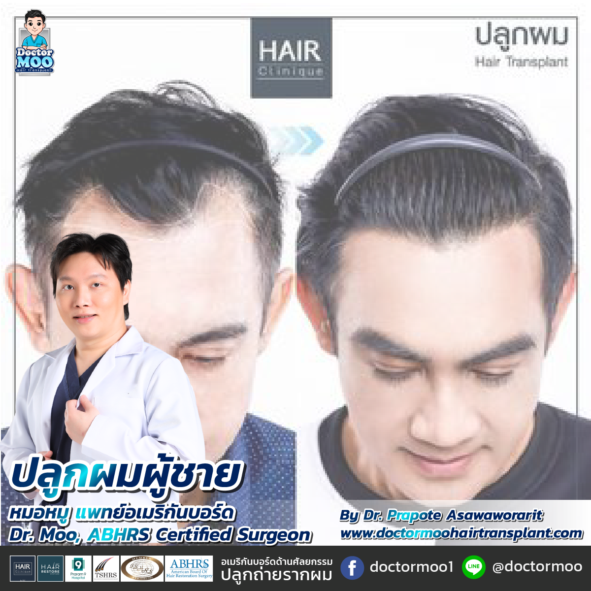 ปลูกผม ผู้ชาย