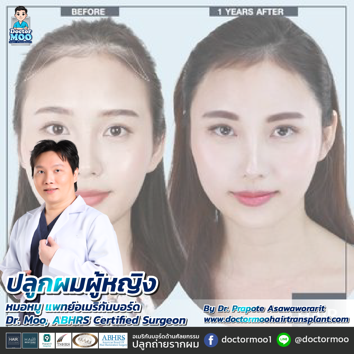 ปลูกผม ผู้หญิง