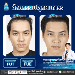 ปลูกผม ผู้ชาย