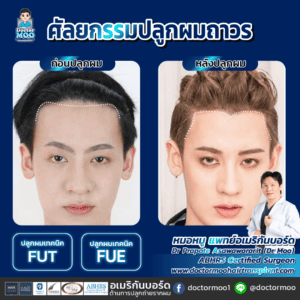 ปลูกผม ผู้ชาย